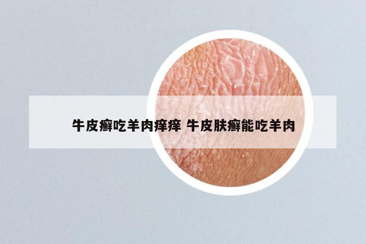 牛皮癣吃羊肉痒痒 牛皮肤癣能吃羊肉