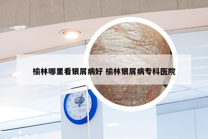 榆林哪里看银屑病好 榆林银屑病专科医院