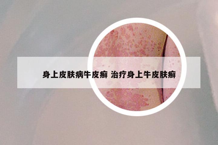 身上皮肤病牛皮癣 治疗身上牛皮肤癣