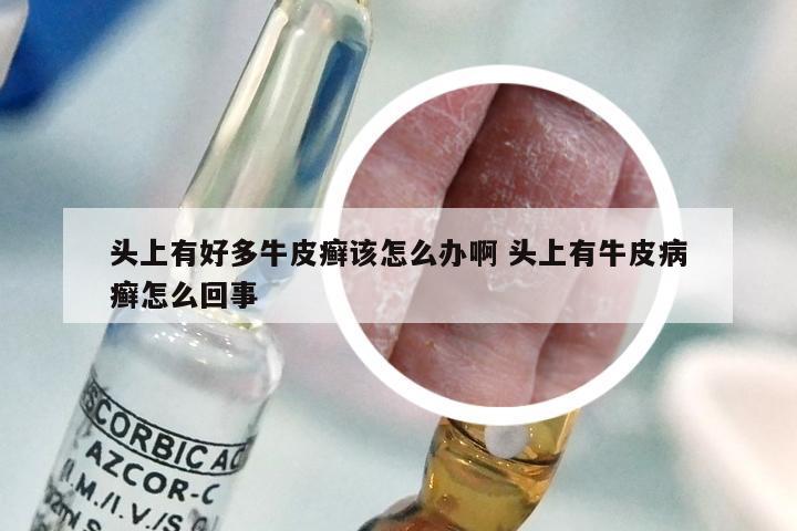 头上有好多牛皮癣该怎么办啊 头上有牛皮病癣怎么回事