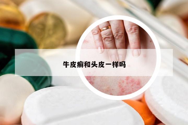 牛皮癣和头皮一样吗