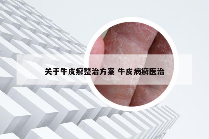 关于牛皮癣整治方案 牛皮病癣医治
