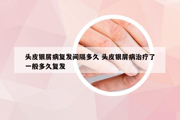 头皮银屑病复发间隔多久 头皮银屑病治疗了一般多久复发