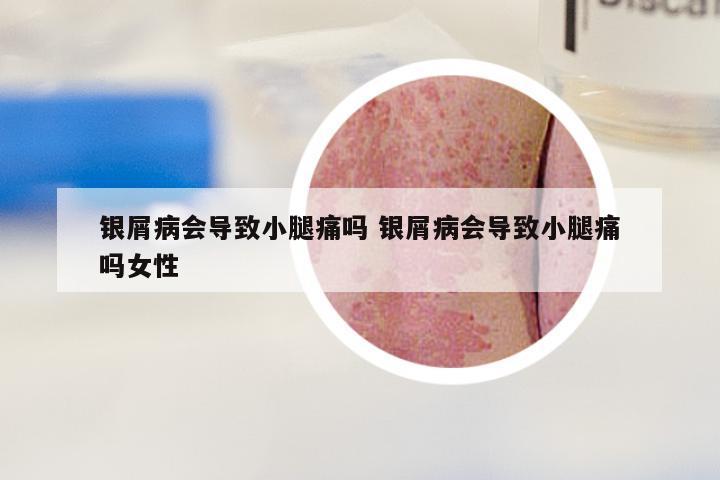 银屑病会导致小腿痛吗 银屑病会导致小腿痛吗女性
