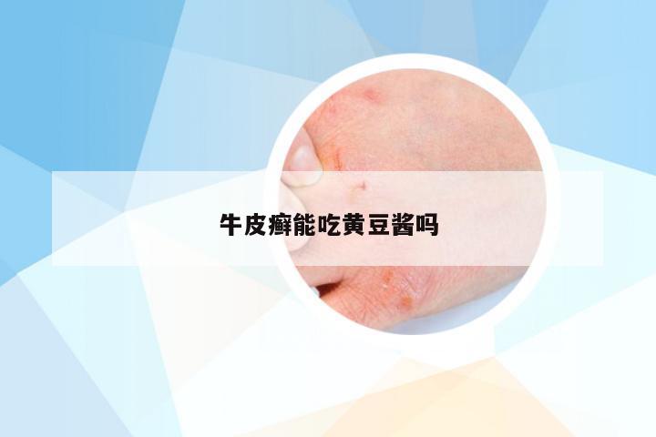 牛皮癣能吃黄豆酱吗