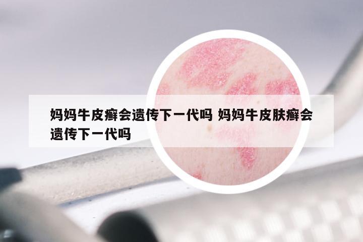 妈妈牛皮癣会遗传下一代吗 妈妈牛皮肤癣会遗传下一代吗