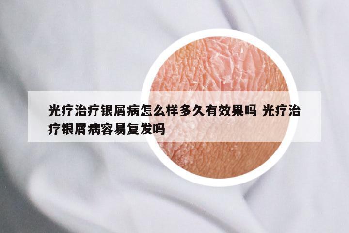 光疗治疗银屑病怎么样多久有效果吗 光疗治疗银屑病容易复发吗
