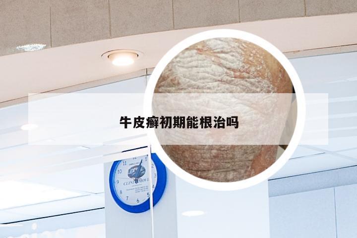 牛皮癣初期能根治吗