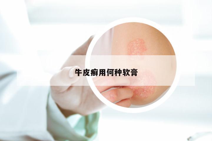 牛皮癣用何种软膏