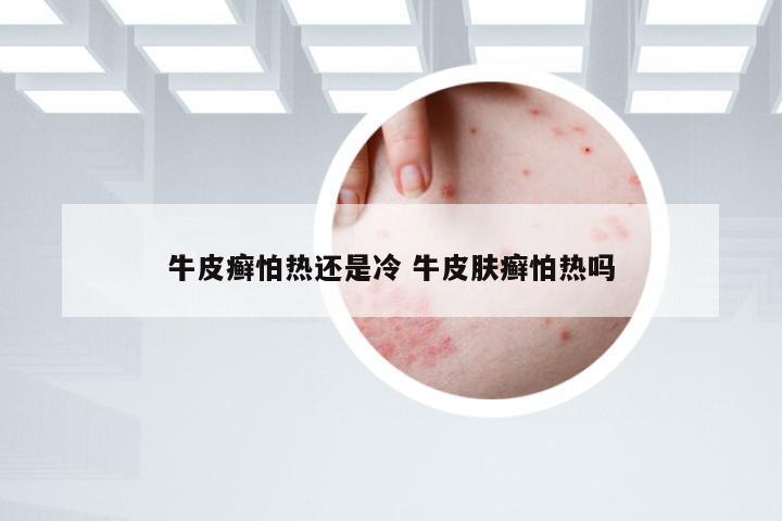 牛皮癣怕热还是冷 牛皮肤癣怕热吗