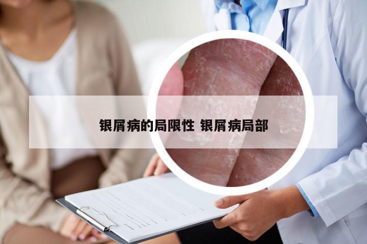 银屑病的局限性 银屑病局部
