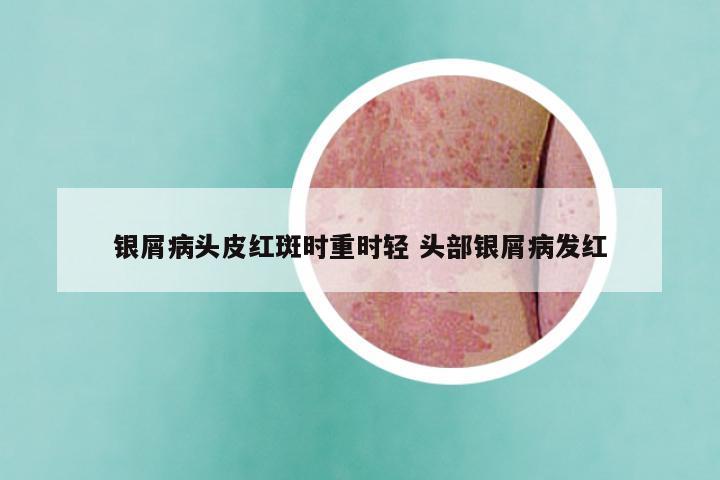 银屑病头皮红斑时重时轻 头部银屑病发红