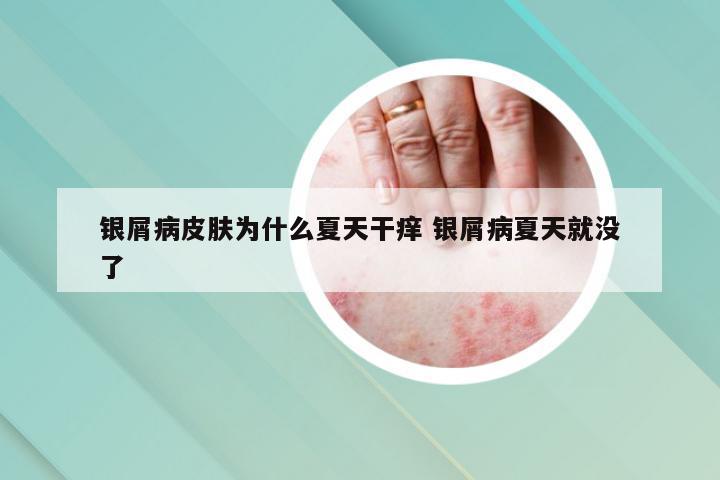 银屑病皮肤为什么夏天干痒 银屑病夏天就没了
