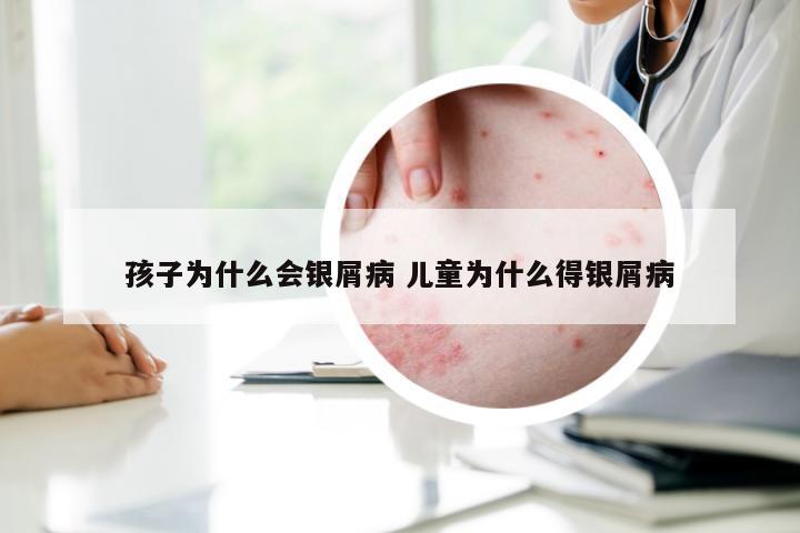 孩子为什么会银屑病 儿童为什么得银屑病
