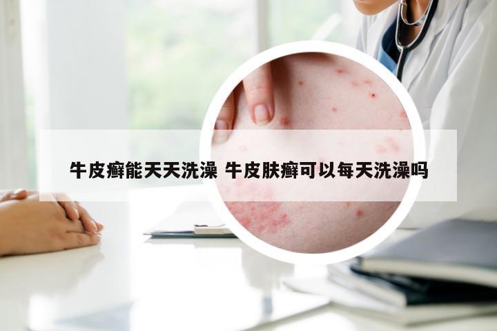 牛皮癣能天天洗澡 牛皮肤癣可以每天洗澡吗