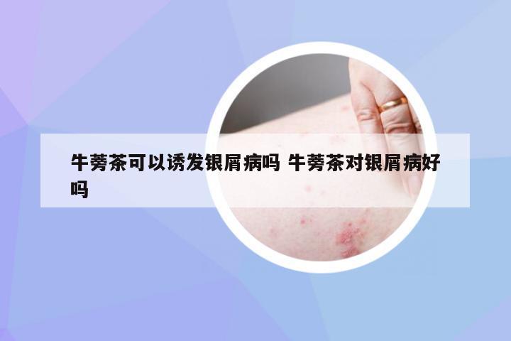 牛蒡茶可以诱发银屑病吗 牛蒡茶对银屑病好吗
