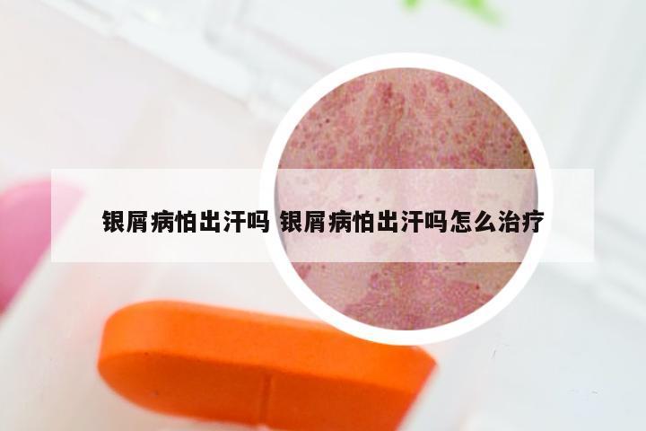 银屑病怕出汗吗 银屑病怕出汗吗怎么治疗