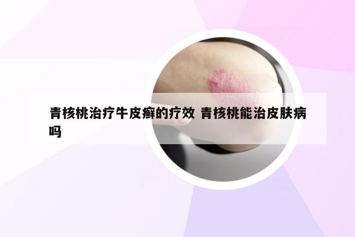 青核桃治疗牛皮癣的疗效 青核桃能治皮肤病吗