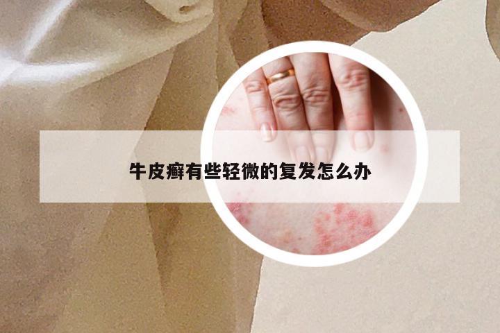 牛皮癣有些轻微的复发怎么办
