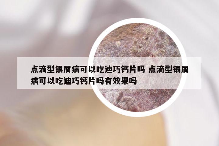 点滴型银屑病可以吃迪巧钙片吗 点滴型银屑病可以吃迪巧钙片吗有效果吗