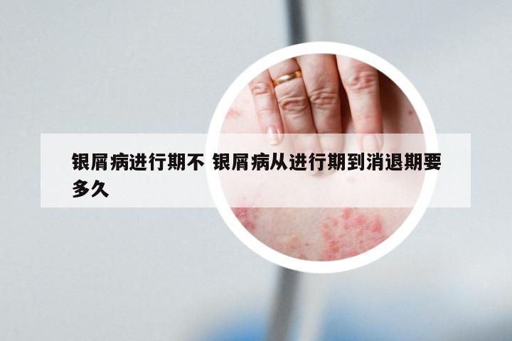银屑病进行期不 银屑病从进行期到消退期要多久