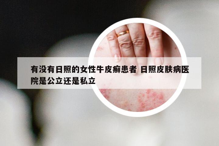 有没有日照的女性牛皮癣患者 日照皮肤病医院是公立还是私立