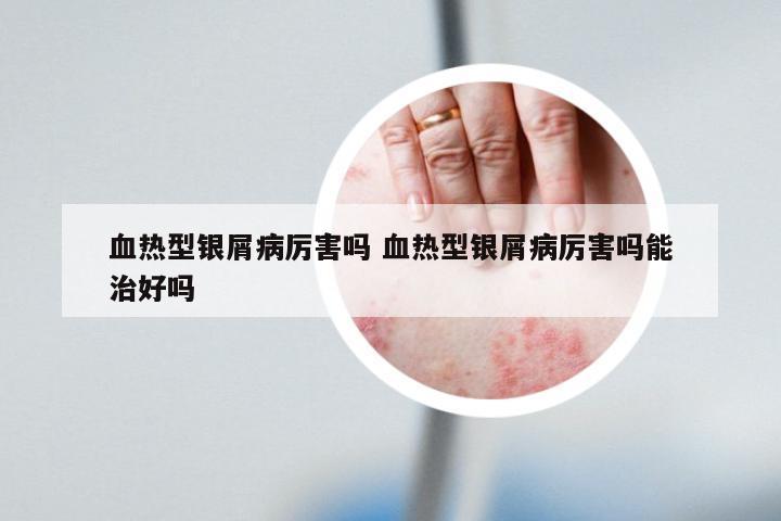 血热型银屑病厉害吗 血热型银屑病厉害吗能治好吗