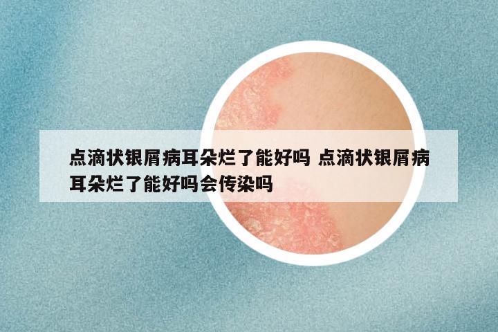 点滴状银屑病耳朵烂了能好吗 点滴状银屑病耳朵烂了能好吗会传染吗