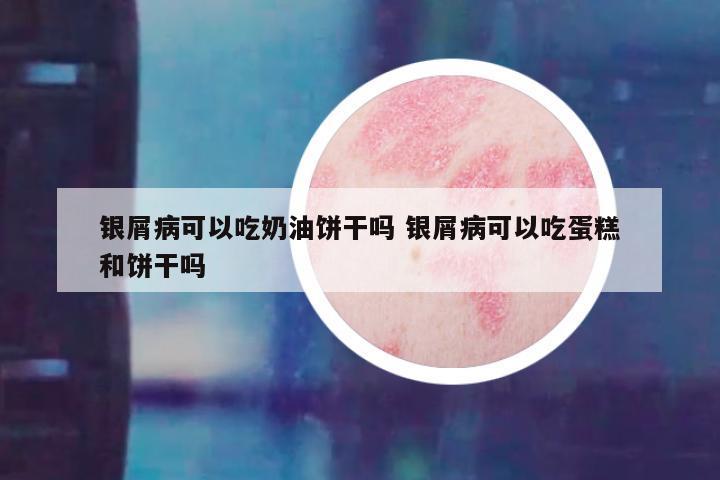银屑病可以吃奶油饼干吗 银屑病可以吃蛋糕和饼干吗