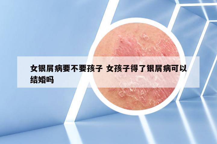 女银屑病要不要孩子 女孩子得了银屑病可以结婚吗