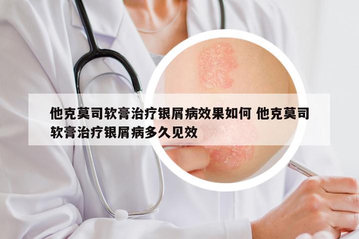 他克莫司软膏治疗银屑病效果如何 他克莫司软膏治疗银屑病多久见效