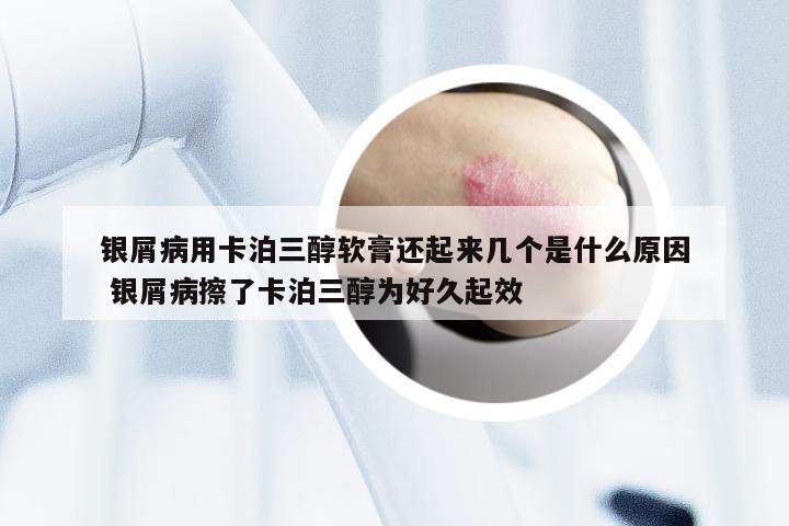 银屑病用卡泊三醇软膏还起来几个是什么原因 银屑病擦了卡泊三醇为好久起效