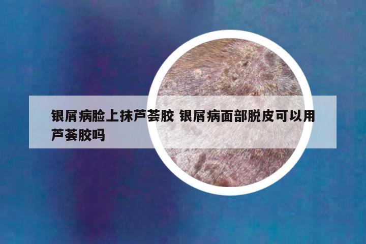 银屑病脸上抹芦荟胶 银屑病面部脱皮可以用芦荟胶吗