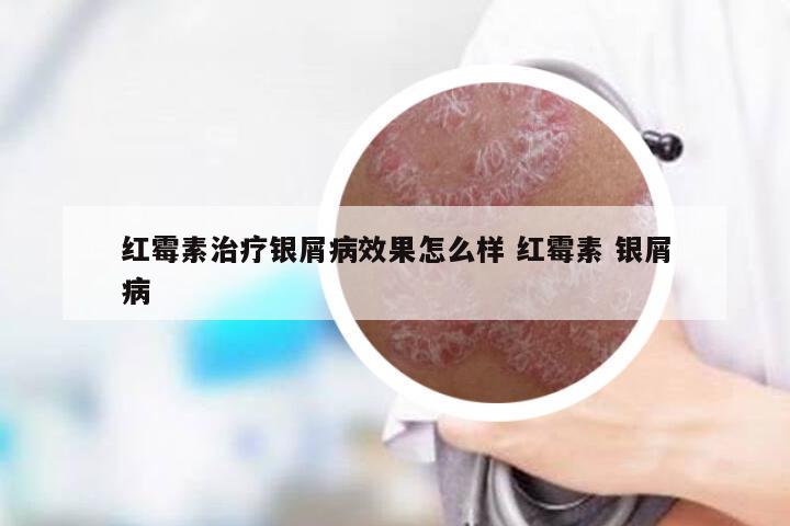 红霉素治疗银屑病效果怎么样 红霉素 银屑病