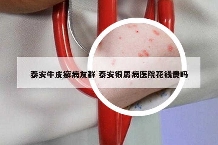 泰安牛皮癣病友群 泰安银屑病医院花钱贵吗