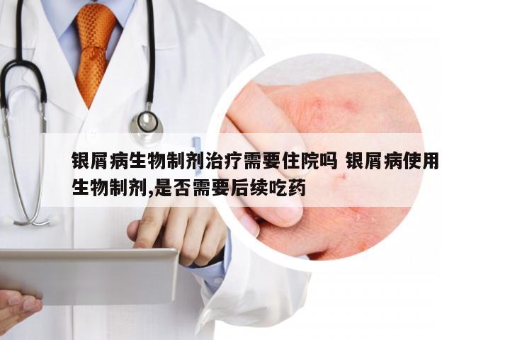 银屑病生物制剂治疗需要住院吗 银屑病使用生物制剂,是否需要后续吃药