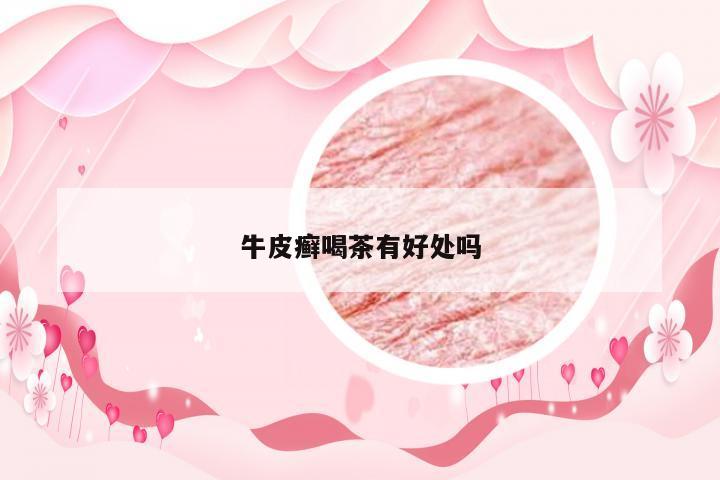牛皮癣喝茶有好处吗