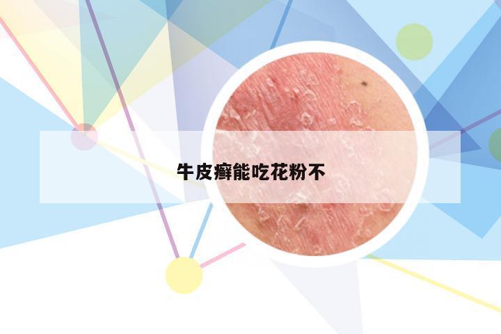 牛皮癣能吃花粉不