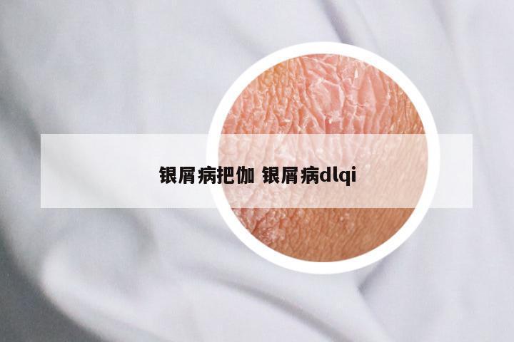银屑病把伽 银屑病dlqi