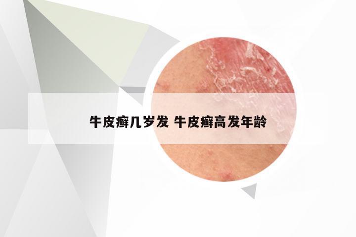 牛皮癣几岁发 牛皮癣高发年龄