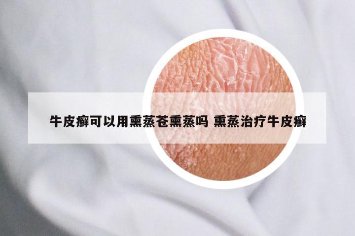 牛皮癣可以用熏蒸苍熏蒸吗 熏蒸治疗牛皮癣