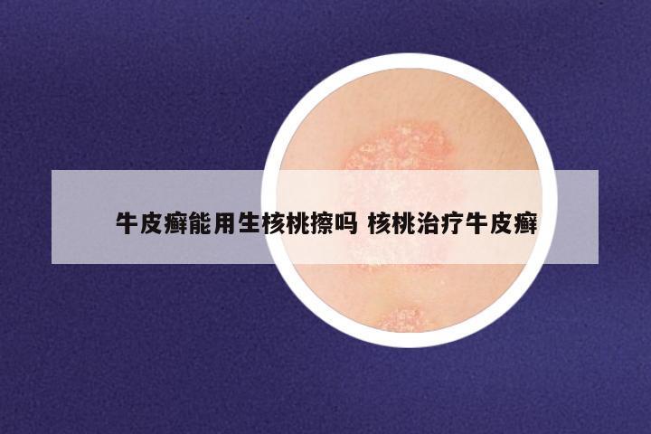 牛皮癣能用生核桃擦吗 核桃治疗牛皮癣