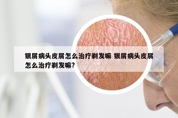 银屑病头皮屑怎么治疗剃发嘛 银屑病头皮屑怎么治疗剃发嘛?