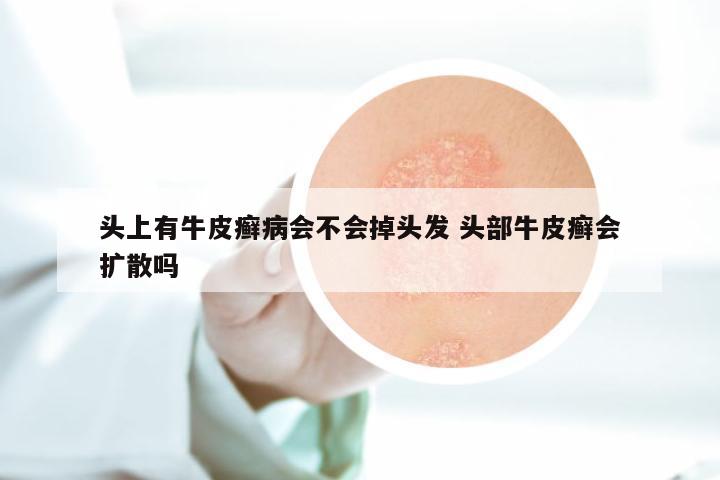 头上有牛皮癣病会不会掉头发 头部牛皮癣会扩散吗