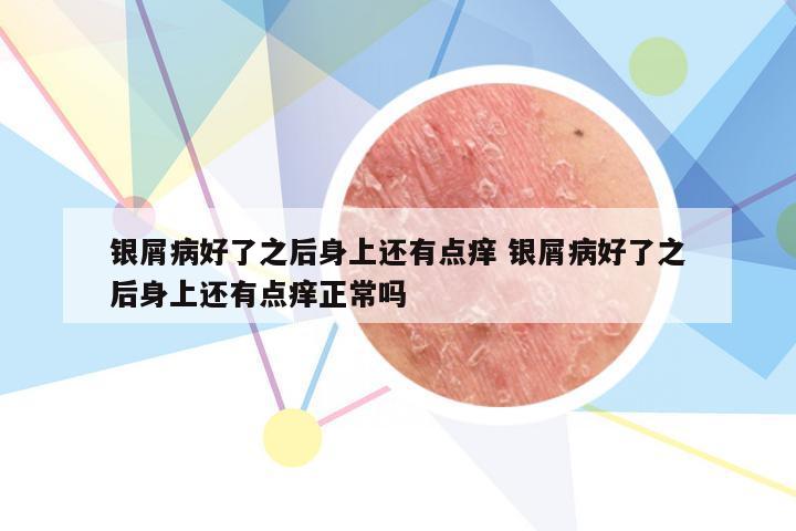 银屑病好了之后身上还有点痒 银屑病好了之后身上还有点痒正常吗
