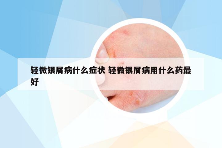轻微银屑病什么症状 轻微银屑病用什么药最好