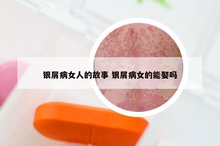 银屑病女人的故事 银屑病女的能娶吗