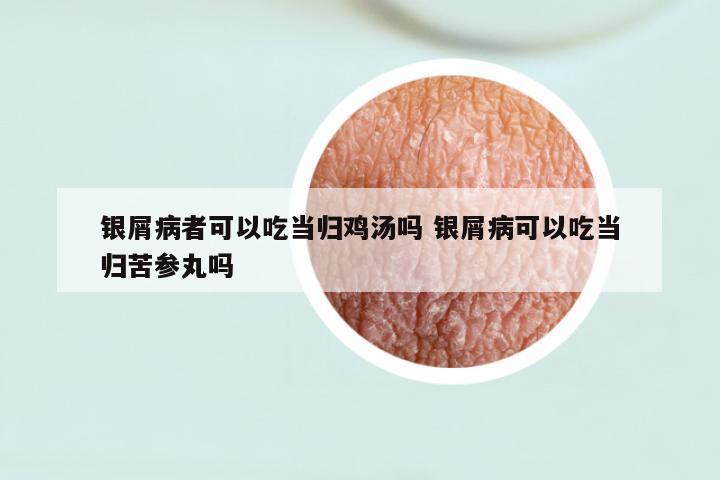 银屑病者可以吃当归鸡汤吗 银屑病可以吃当归苦参丸吗