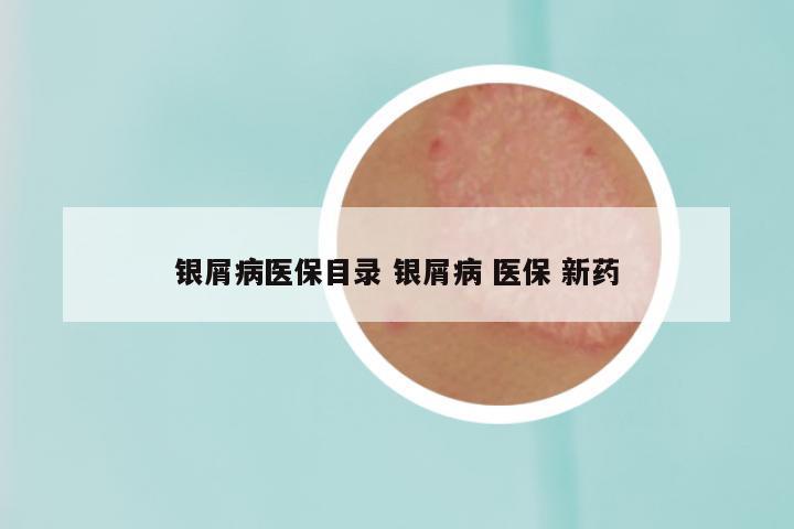 银屑病医保目录 银屑病 医保 新药