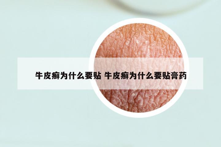 牛皮癣为什么要贴 牛皮癣为什么要贴膏药